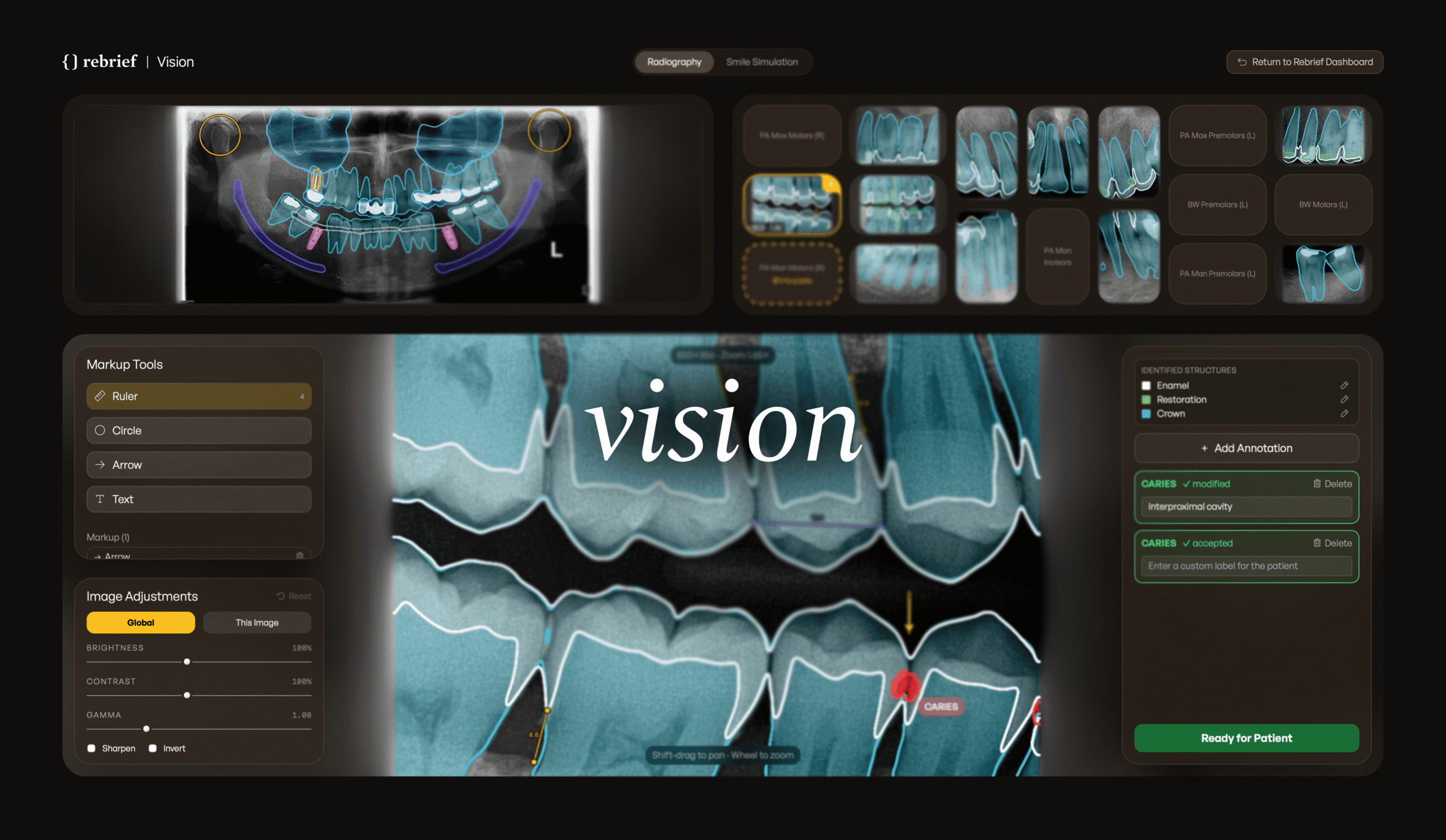 Rebrief Vision — segmented radiography and smile simulation shown side by side in the case presentation view